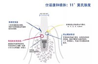 韓國仕諾康snuc種植牙