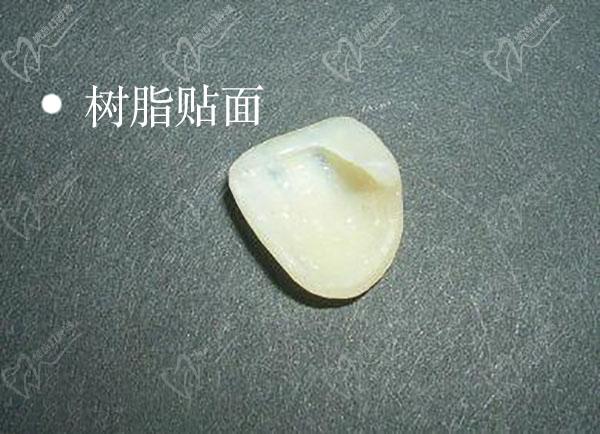 樹脂貼面（冰瓷貼面）