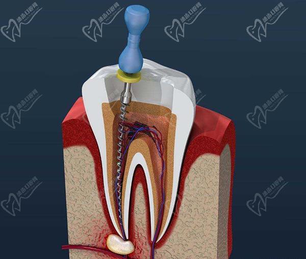 根管治療過(guò)程圖