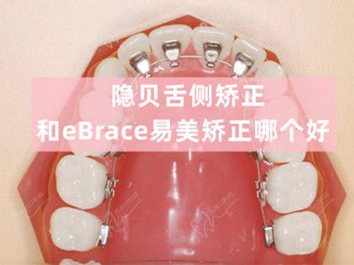 隱貝舌側(cè)矯正和eBrace易美矯正哪個好