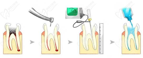 根管治療怎么操作