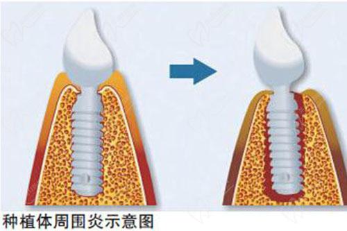 種植體周圍炎