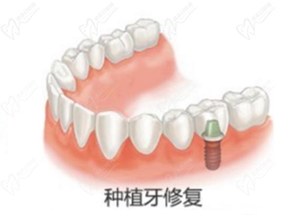 牙齒種植