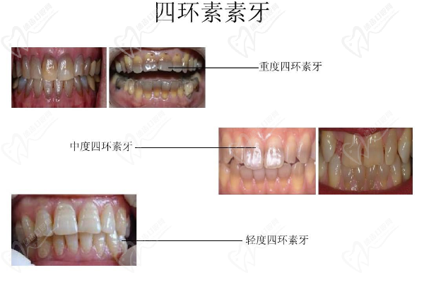 四環(huán)素牙美白價格