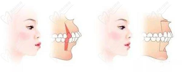 牙齒前凸矯正