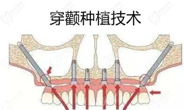 穿顴種植牙