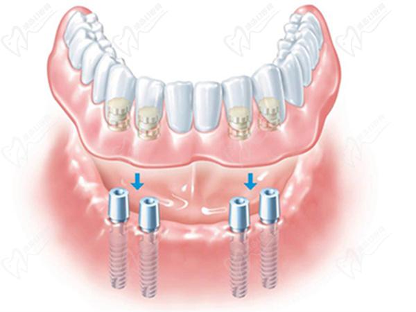 All-on-4種植牙