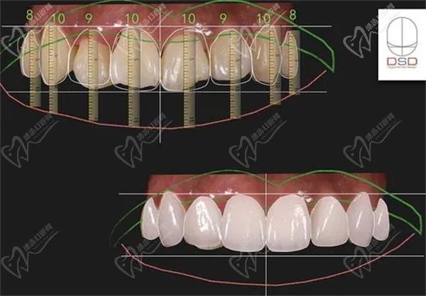 DSD牙齒美學修復技術