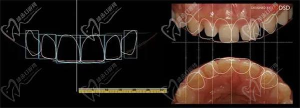 DSD牙齒美學修復技術