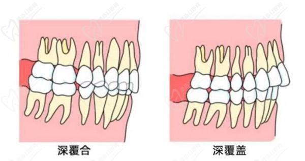 牙齒只深覆蓋正常嗎？深覆蓋有必要矯正嗎？看矯正后臉型變化