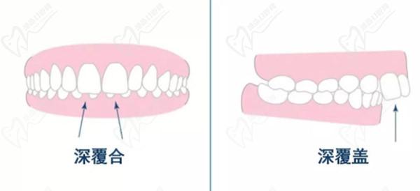 牙齒只深覆蓋正常嗎？深覆蓋有必要矯正嗎？看矯正后臉型變化