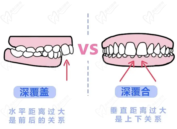 牙齒只深覆蓋正常嗎？深覆蓋有必要矯正嗎？看矯正后臉型變化