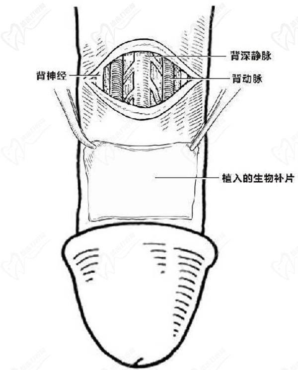 生物補片增粗手術(shù)<span style=