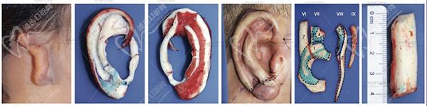 康春雨擴(kuò)張單瓣兩次法外耳再造技術(shù)流程