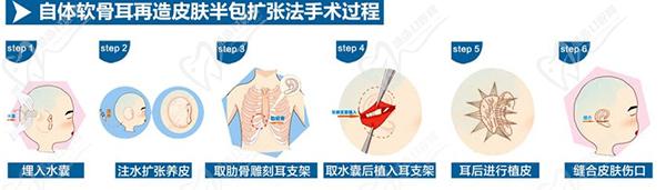 北京麗都耳再造中心耳再造技術