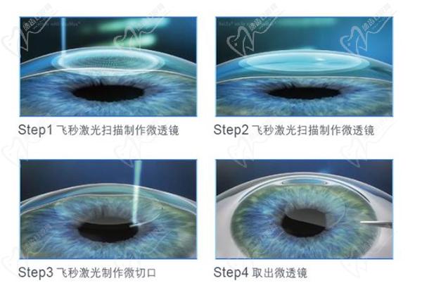 蔡司全飛秒smile3.0屈光矯正手術(shù)優(yōu)勢