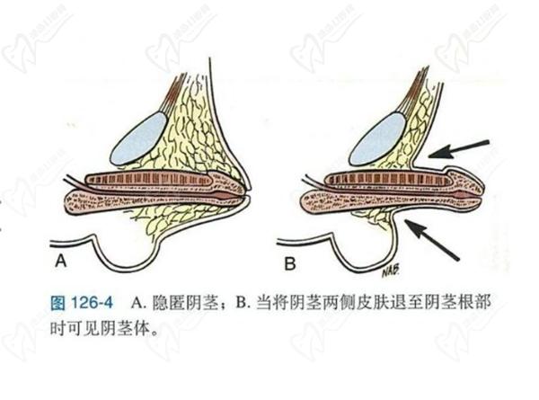 生殖延長(zhǎng)整形手術(shù)多久有成效