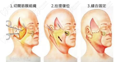 黃廣香拉皮手術(shù)做得怎么樣