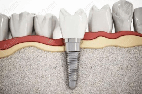種植牙與傳統(tǒng)鑲牙哪個(gè)好？