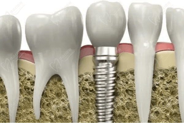 種植牙與傳統(tǒng)鑲牙哪個(gè)好？