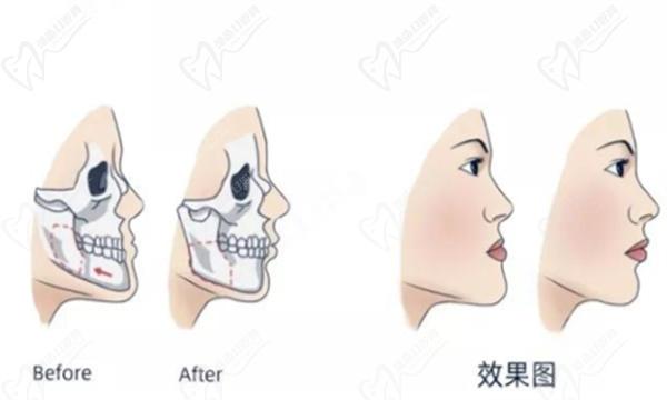 17歲可以做正頜手術(shù)嗎