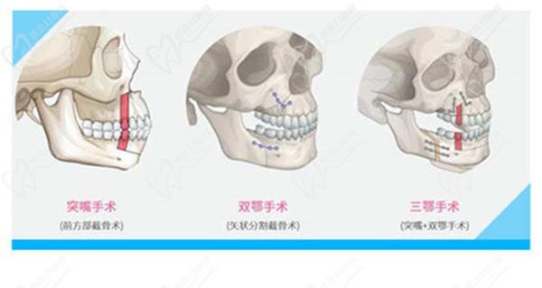 17歲可以做正頜手術(shù)嗎