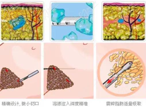 南京張讓虎抽脂怎么樣