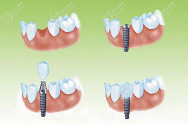 種植牙選哪種價(jià)格好