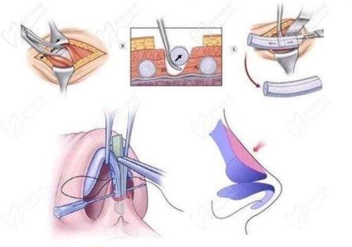 耳軟骨隆鼻有什么風(fēng)險(xiǎn)和后遺癥？