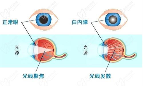 老花眼與白內(nèi)障是同一回事嗎